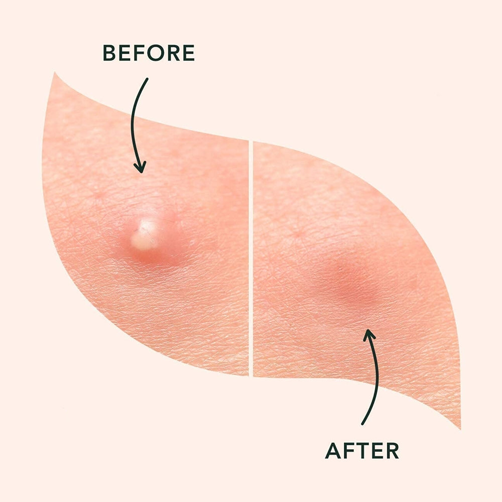Acne Pimple Patch